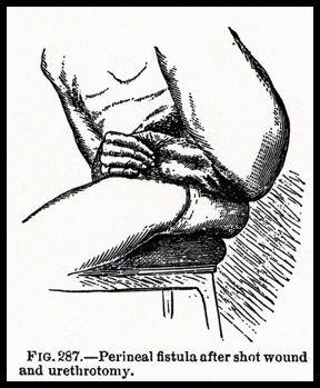 Chronic Urethrocutaneous Fistula
