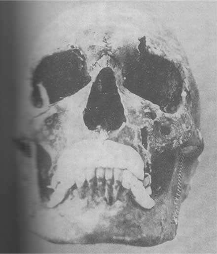 Josef Menegels skull, used to identify his body.