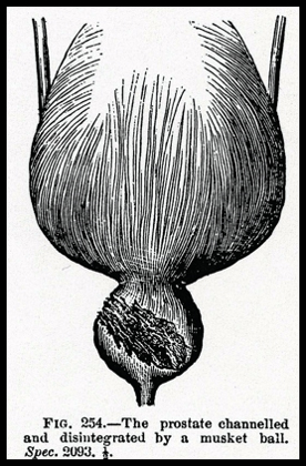 Prostatic Laceration