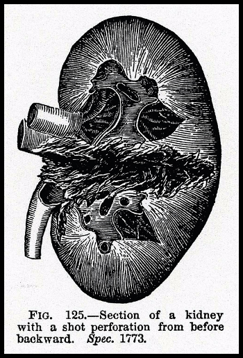 Renal Laceration