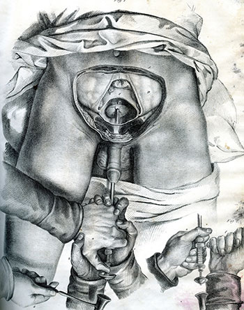 A Treatise on Operative Surgery, Joseph Pancoast